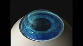 Epi-Lasik/Lasek - by Patient Education Concepts