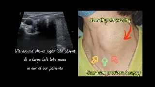 Recurrent thyroid swelling post thyroidectomy PYT2