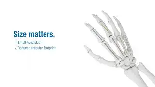 Minimize articular damage with TriMed's Small Threaded IM Nails