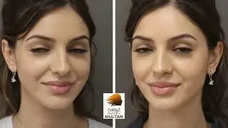 Face Slimming Botox