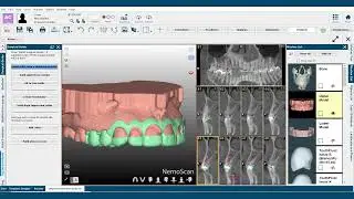 Guia para Gengivoplastia com o NemoScan