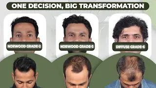 Hair Transplant in Hyderabad | Best Results & Cost of Hair Transplant in Hyderabad