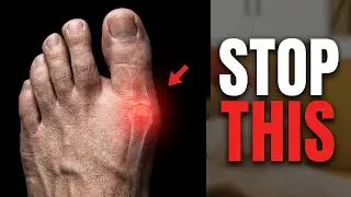 Gout Attacks Don't Have to Happen: Here's Why