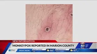 Two probable cases of monkeypox virus found in Indianapolis