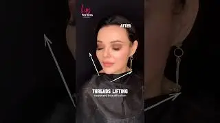 Threads lifting #recommended #рек #top #beauty #aesthetic #lifting #lips #botox #jawline #skincare
