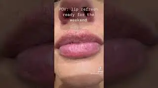 0.5ml juvederm smile to give a great lip refresh #filler #lipfiller #juvederm #dermalfillers #lips