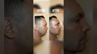 Before & After - JAWLINE  AND CHIN FILLER🪄 Dr. Jarrett Schanzer #jawlinefiller #chinfiller