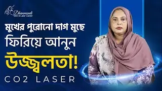 মুখের দাগ দূর করুন স্থায়ীভাবে | CO₂ Laser Treatment Bangladesh মুখের গর্ত দূর করার উপায় 