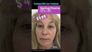 Incredible Fractional CO2 Laser Treatment BEFORE & AFTER #cosmeticdoc #skincare #antiaging #shorts
