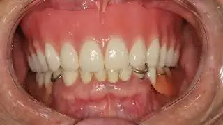Digital Dentures: Revolutionizing the Process from Scan to Design to Delivery