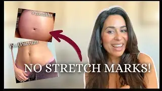 How to Prevent Stretch Marks During Pregnancy | The Skin Care Routine I Used