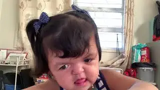 Apert Syndrome Baby: Adi Hernandez: Peek a Boo