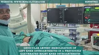 Genicular Artery Embolisation (GAE) for Left Knee Osteoarthritis | Dr. Sandeep Sharma | IRFacilities