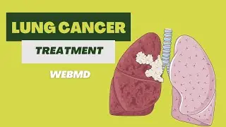 Today's Treatment Options for Lung Cancer | 2D Medical Animation | Pixeldust Studios