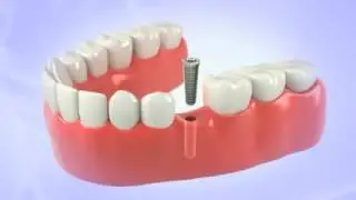 Dental Implants To Replace Missing Teeth - San Diego, CA - The Art of Dentistry