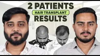 Hair Transplant in Madurai (HX-ZXDT) | Best Results & Cost of Hair Transplant in Madurai.