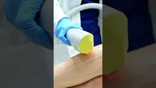 Depilaci&oacute;n con IPL (EXILITE)