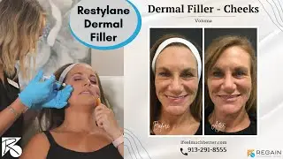 Restylane Dermal Filler for Cheeks near Kansas City