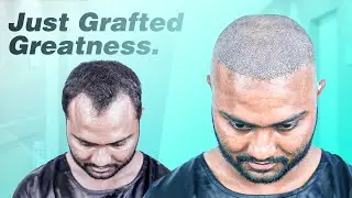 Behind the Scenes of a Hair Transplant Surgery in Bangladesh | Friend of @MehediHassanvlogs