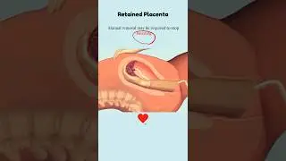 Retained Placenta