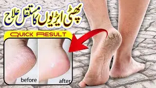cracked heels treatment | phati erian / dry heel permanent treatment