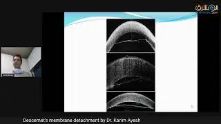 Descemet's membrane detachment by Dr. Karim Ayesh