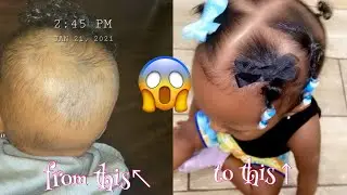 How to grow baby bald spot FAST!!