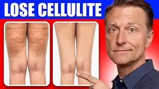 🔥 Get Rid of Cellulite for Good: Dr. Berg's Better Way to Lose Flabby Fat | Health Motivational