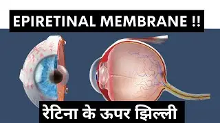 Retina पर झिल्ली !  क्या है Epiretinal Membrane (ERM)