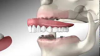 Eat and Smile with an Implant Anchored Denture from Renew