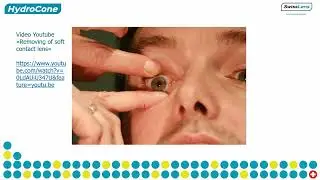 Applicazione delle lenti morbide per cheratocono Hydrocone