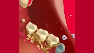 ASMR So Satisfying Caries Removal Animation | Dental care Molar Tooth Caries Restoration