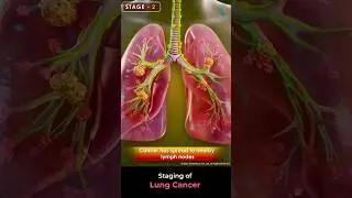 Staging of Lung Cancer ↪ 3D Medical Animation&nbsp;#Shorts&nbsp;#LungCancer&nbsp;#Lung #Cancer #shorts