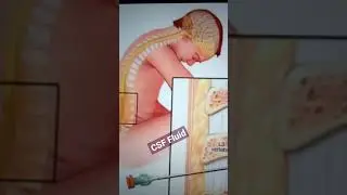 Место сбора спинномозговой жидкости #шорты