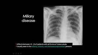 TB imaging overview DRE Prof  Mamdouh Mahfouz HD