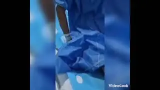Left Hip Replacement, Hip Osteoarthritis with instability with AVN