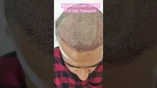 Rs 25000 FUE Hair Transplant. Natural hairline. Irregularly irregular. 9416500112