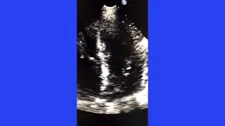 Constrictive Pericarditis