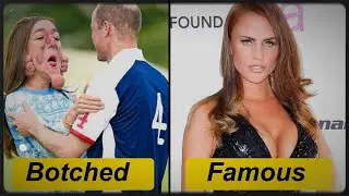 Unsuccessful Plastic Surgeries Have Made Them Unrecognizable