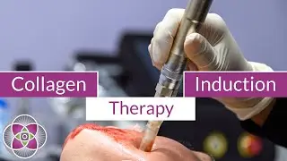 Collagen Induction Therapy Before & After Micro Needling