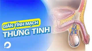 Bệnh Giãn Tĩnh Mạch Thừng Tinh | Dấu Hiệu Và Cách Điều Trị