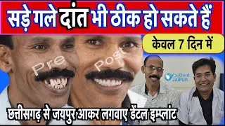 दांत का इम्प्लांट कैसे होता है ? दांत कितने भी ख़राब हो सुन्दर बनाया जा सकता है |YouDent Hospital .
