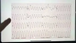 How do we see arrhythmia on an ECG?