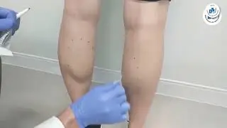 Trẻ hóa da bằng độc tố Botulinum Toxin