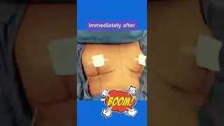 Breast Lift Before and After #shorts