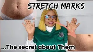 Stretch Marks: The Truth about it, How it happens, the Prevention and Cure for stetchmarks