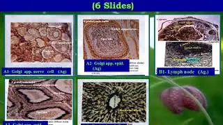 2 G2 slides identified by  special stain & confirmed by LP & HP