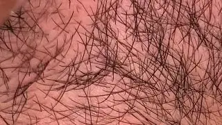 ASMR ingrown satisfying long hair video #1000subscriber #skincare #asmrtriggers