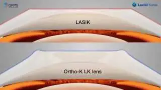 Ortho-K LK Lens