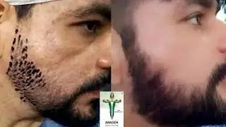 Beard Transplant in Mumbai